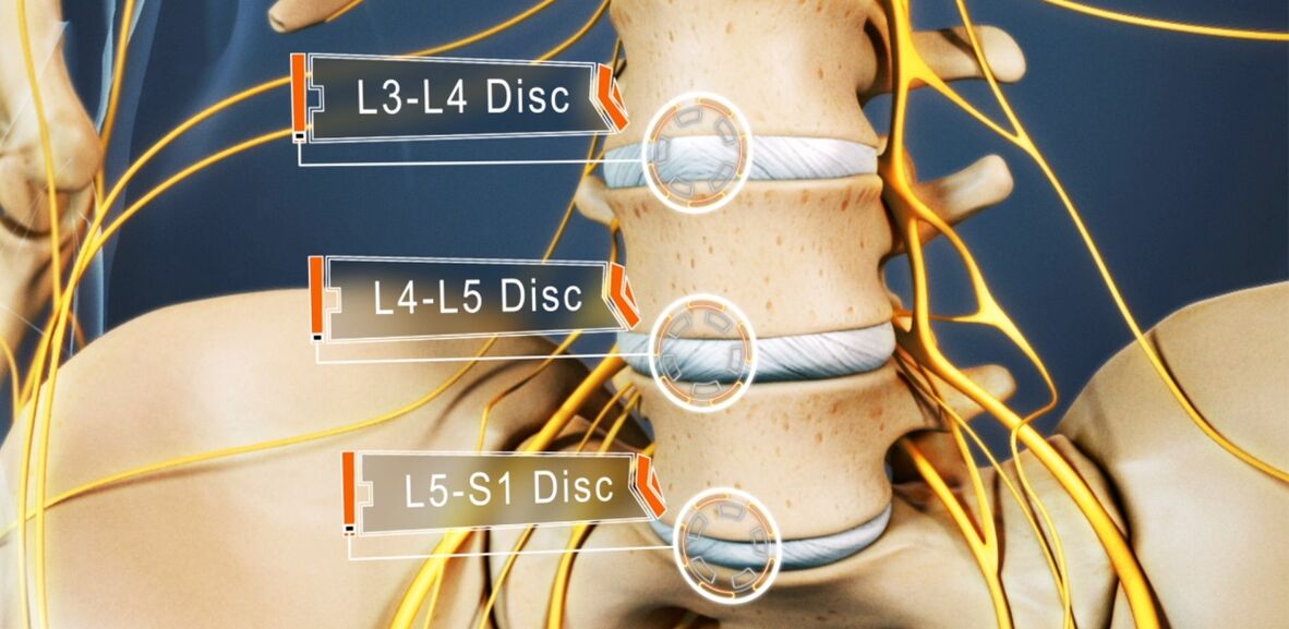 Discs nke spine lumbar, nke na-emetụtakarị na osteochondrosis