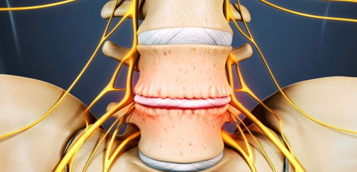 Osteochondrosis nke spine lumbar