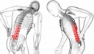 Intertebrebrebrebrebrebrebrebrebrebrebril Hernia - nsogbu na osteochondrosis