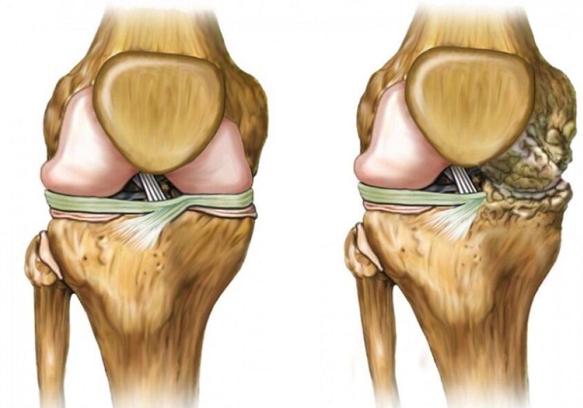 Arthrosis nke ikpere
