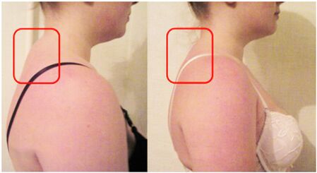 Guzo nke akwara nke nwere osteochondrosis cervical