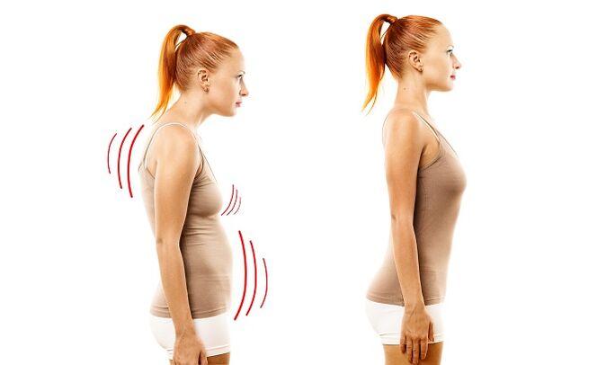 Stuping dị ka ihe kpatara mmepe nke lumbar osteochondrosis