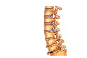 Imebi spain na osteochondrosis cervical