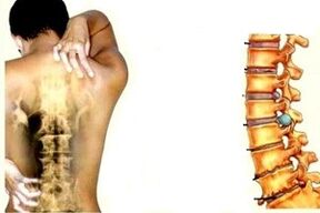 azụ mgbu na ọkwa dị iche iche nke mmepe nke osteochondrosis cervical