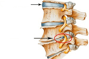 diski nkịtị na nke mebiri emebi na osteochondrosis calvond