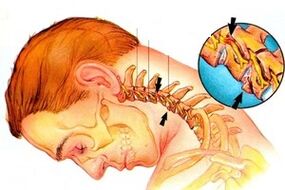 pinchi nke akwara na spain na osteochondrosis calrical