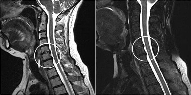 MRI nke Cervical Spain