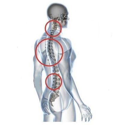 saịtị nke spinal osteochondrosis
