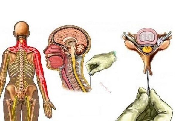 Ọgwụgwọ Osteochondrosis cervical na acupuncture