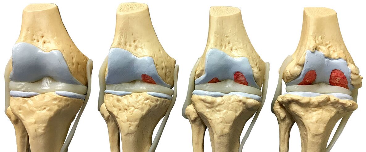 ogbo nke arthrosis