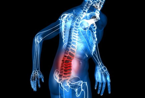 Gịnị bụ lumbar osteochondrosis
