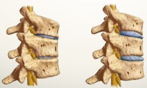 Kedu ka osteochondrosis si dị