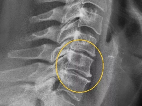 Osteochondrosis nke spine cervical na x-ray